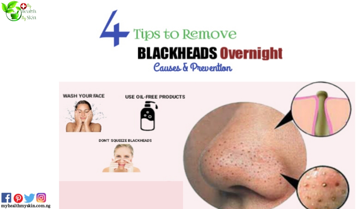 Blackheads home remedies