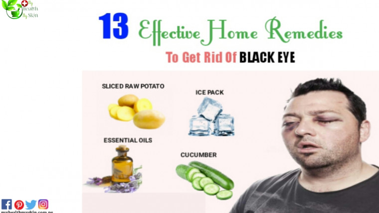 home remedies for black eye