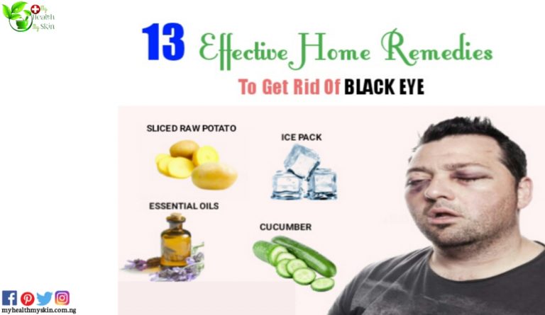 black-eye-23-incredible-ways-to-treat-a-black-eye-at-home