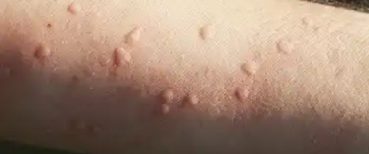 Skin Reaction