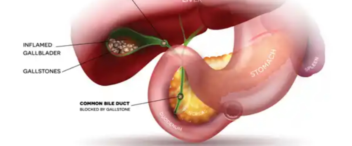 Gallstones and Gallbladder Issues diagram