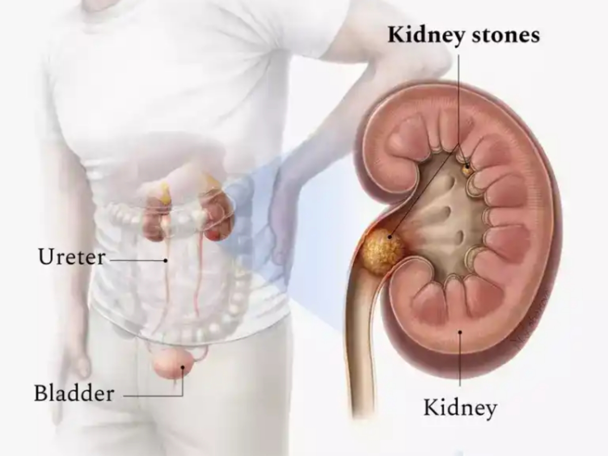 kidney stones diagram