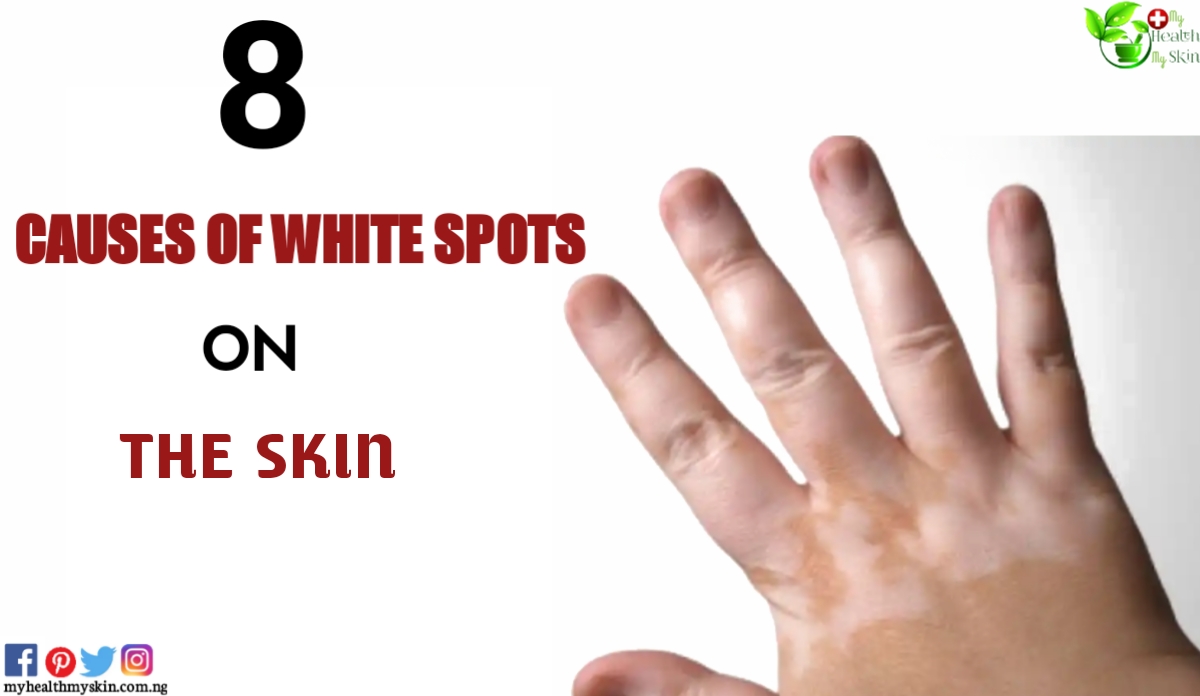 8 Causes Of White Spots On The Skin