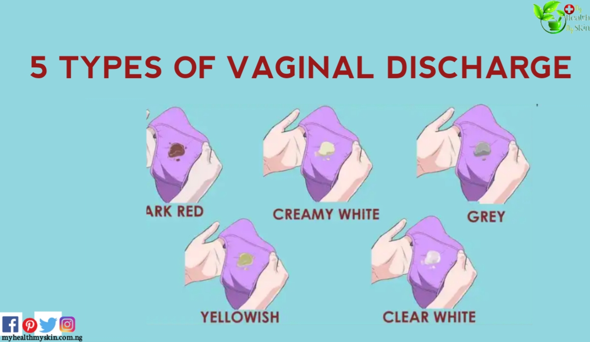 types of virgina discharge