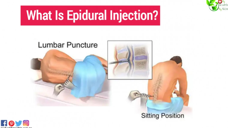 what is epidural injection