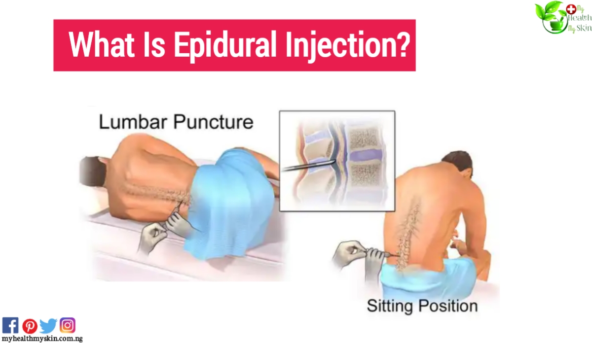 what is epidural injection