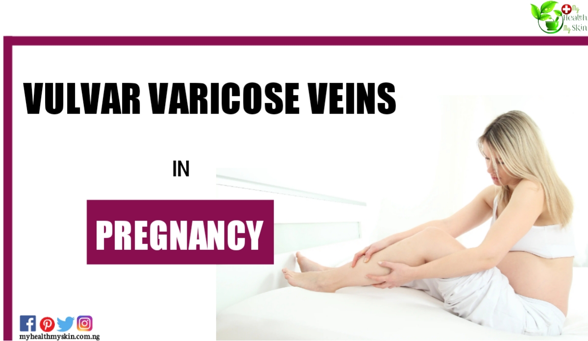 Vulvar Varicose Veins In Pregnancy