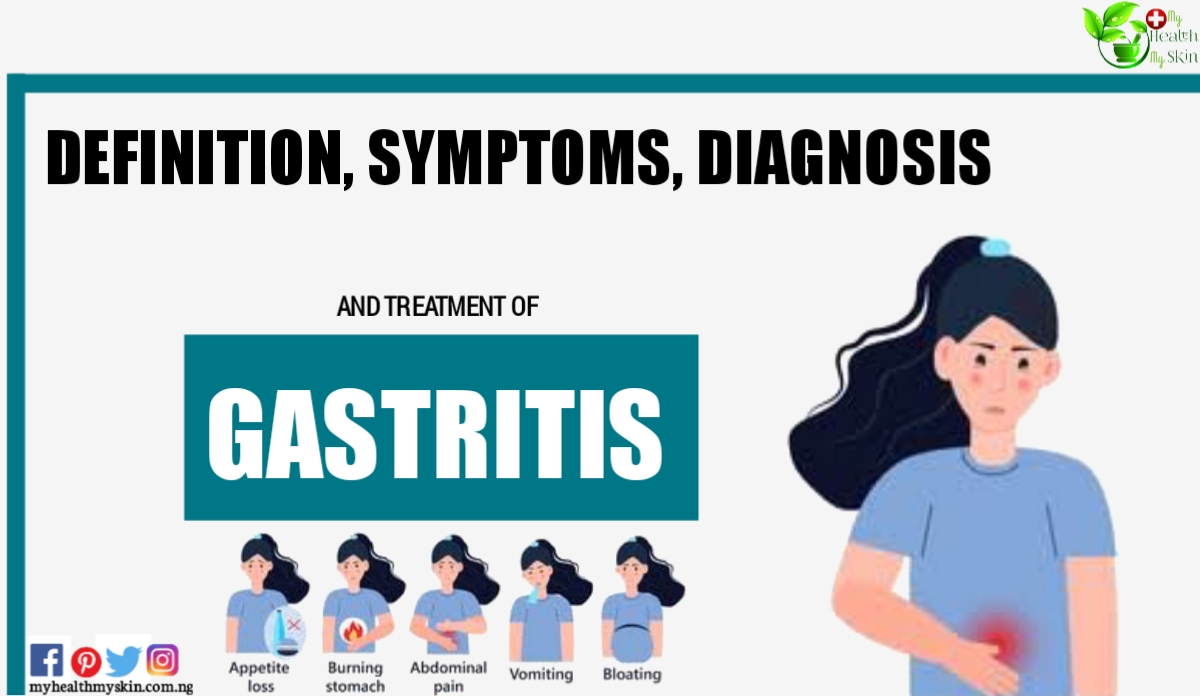 Gastritis: Definition, Symptoms, Diagnosis And Treatment