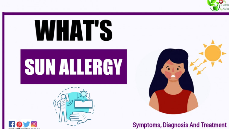 Sun allergy Whats it Symptoms Diagnosis And Treatment