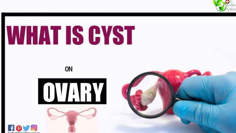 What Is Cyst On Ovary Different Types of Cysts