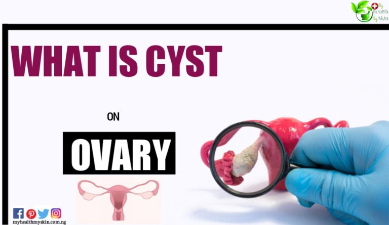 What Is Cyst On Ovary? Different Types Of Cysts