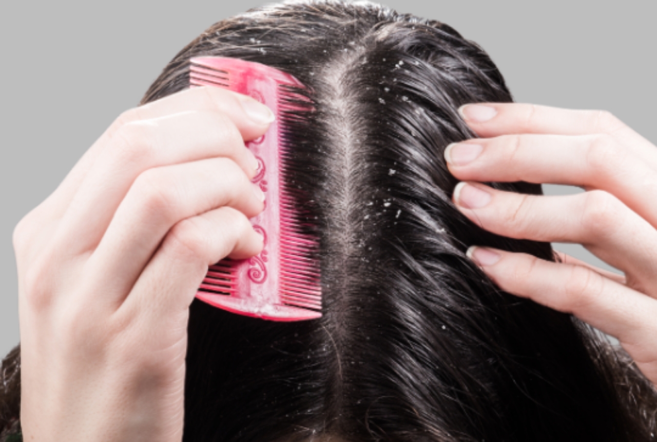 Woman combing her dandruff and itchy scalp hair