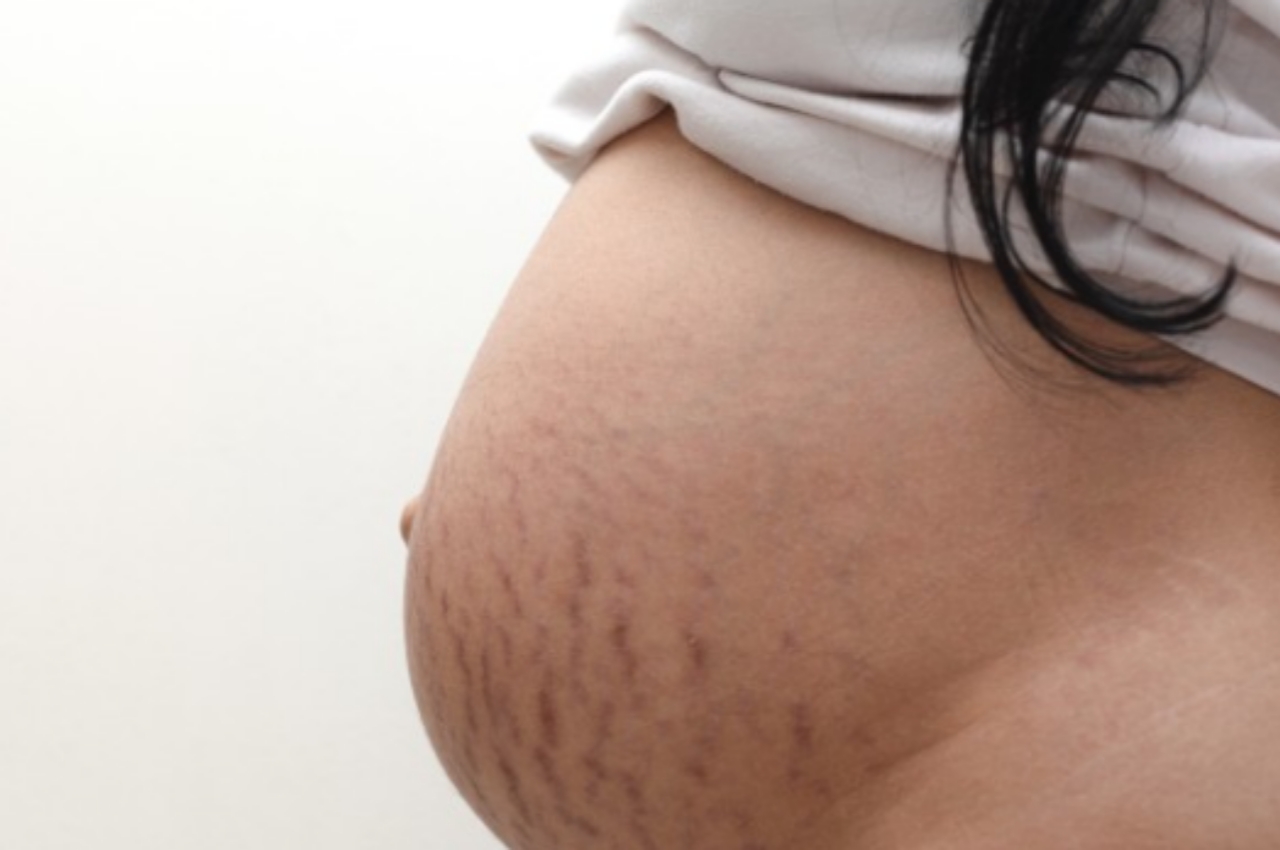3 Types Of Stretch Marks And Best Treatments