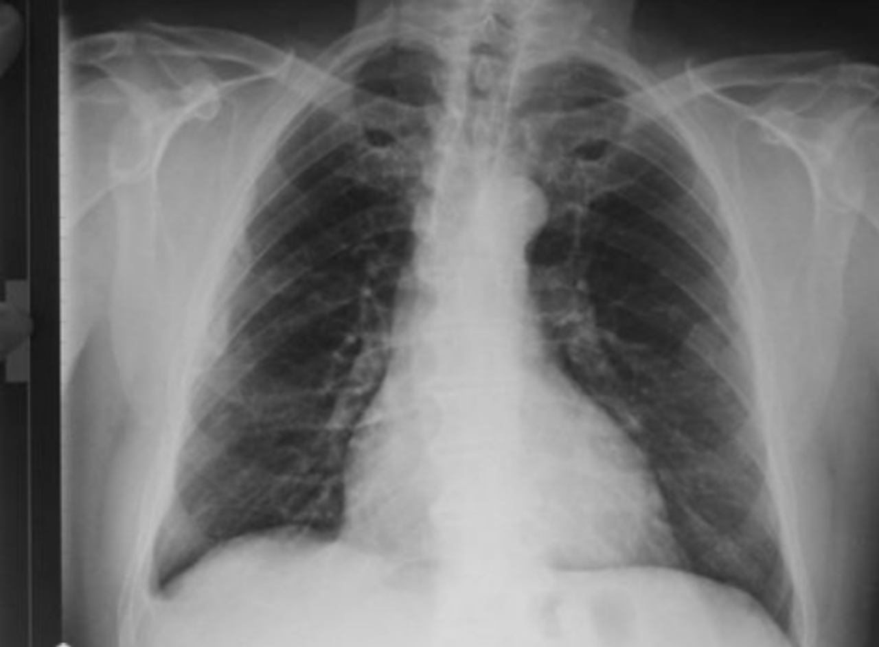 Lung Cancer From Asbestos: How Asbestos Increases The Risk Of Cancer