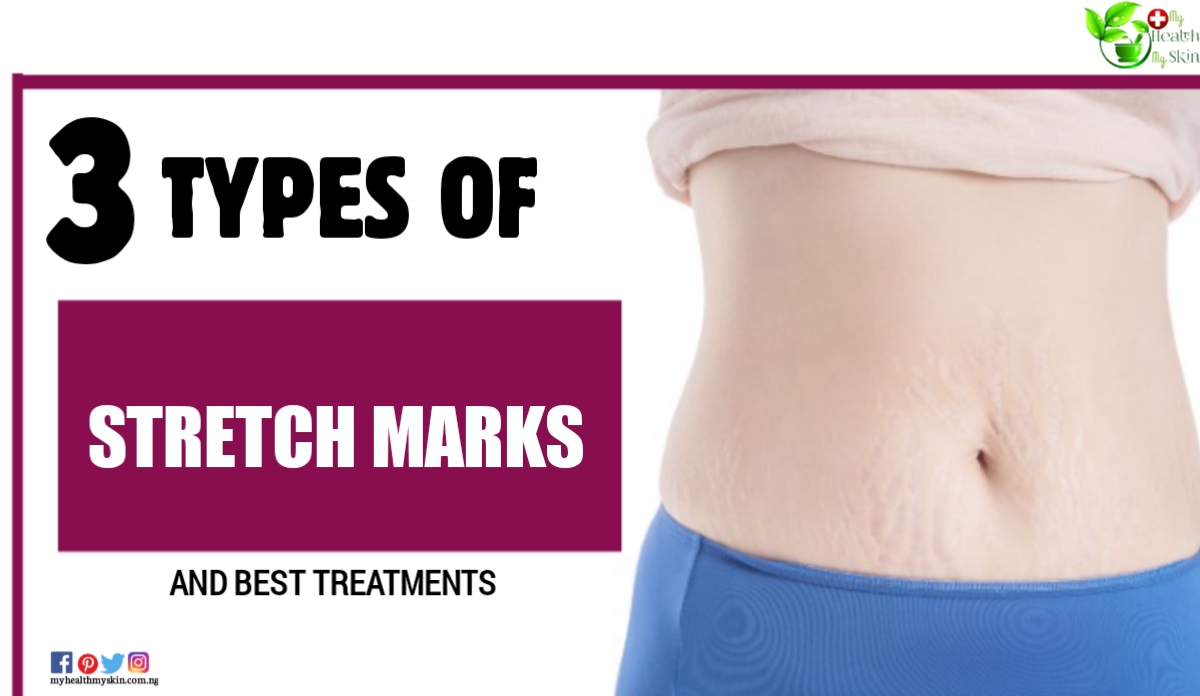 3 Types Of Stretch Marks And Best Treatments