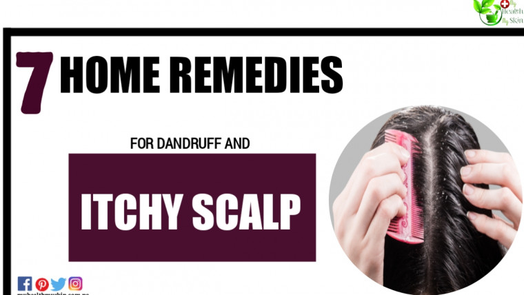 7 Home Remedies for Dandruff and Itchy Scalp