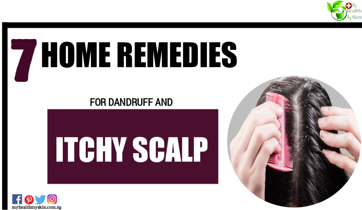 7 Home Remedies for Dandruff and Itchy Scalp