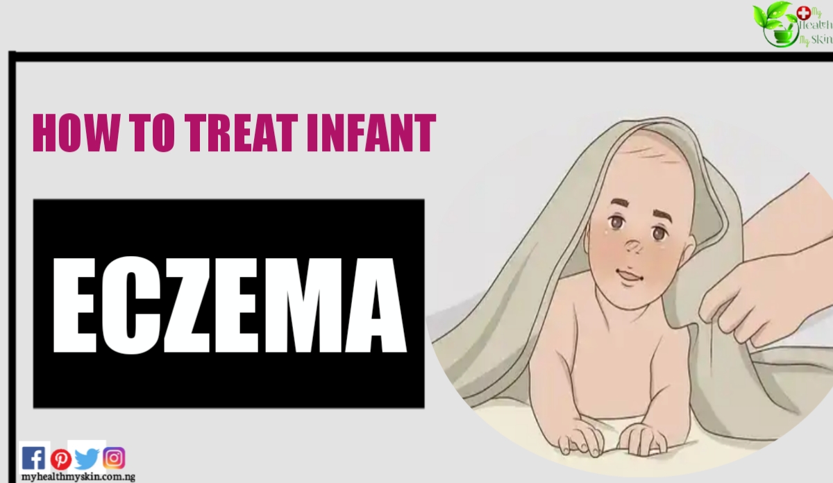 Baby Eczema How To Treat Infant Eczema 1