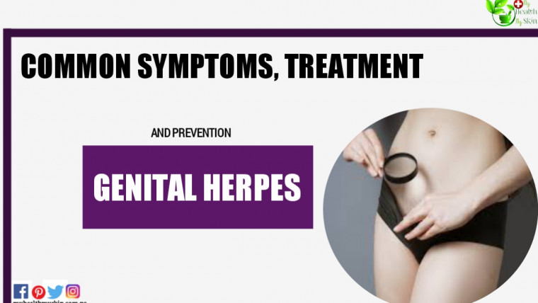Genital Herpes: Common Symptoms, Treatment And Prevention