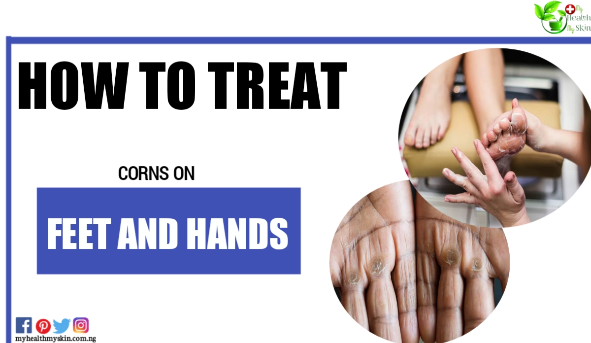 How To Treat Corns On Feet And Hands