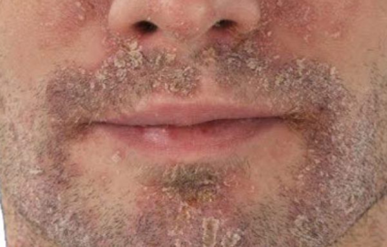 How To Get Rid Of Redness And Peeling Of The Skin On The Face?