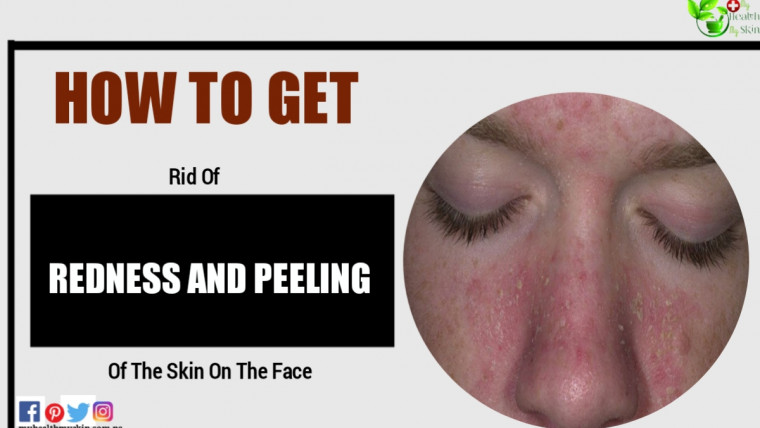 How To Get Rid Of Redness And Peeling Of The Skin On The Face?
