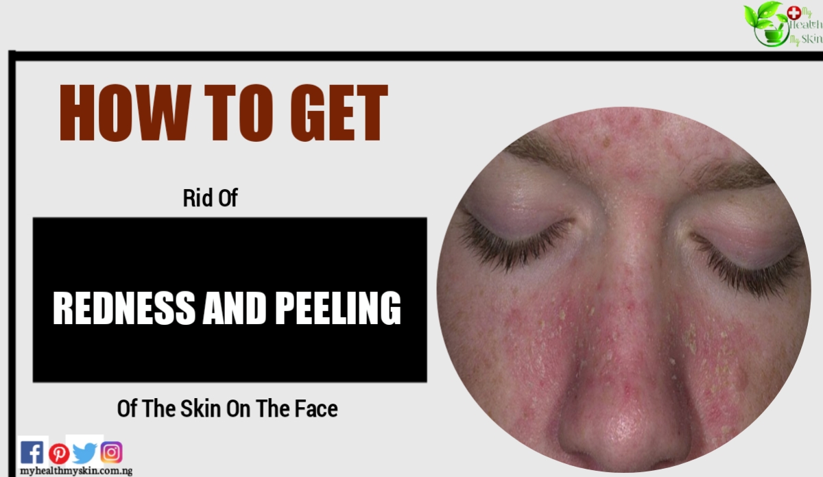 How To Get Rid Of Redness And Peeling Of The Skin On The Face