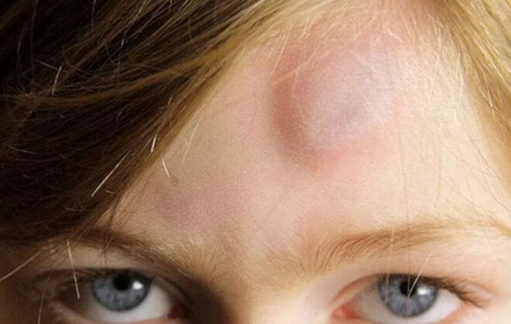 Bump (Atheroma, Sebaceous Gland Cyst) On The Head - Causes, Symptoms, Consequences