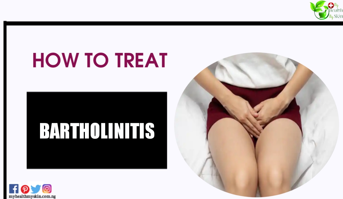 How To Treat Bartholinitis
