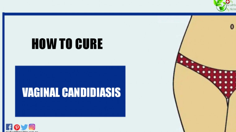 How To Cure Vaginal Candidiasis