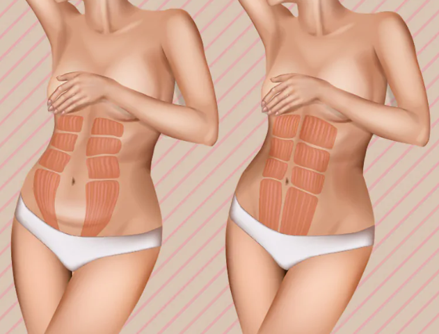 All About Tummy Tuck [Abdominoplasty] - The Complete Guide to Surgery That Can Eliminate Abdominal Flaccidity