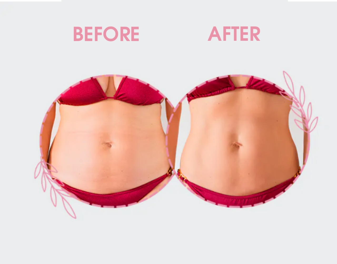 Tummy Tuck Before And After: See Photos Of Celebrities And Discover How To Have A Great Result!