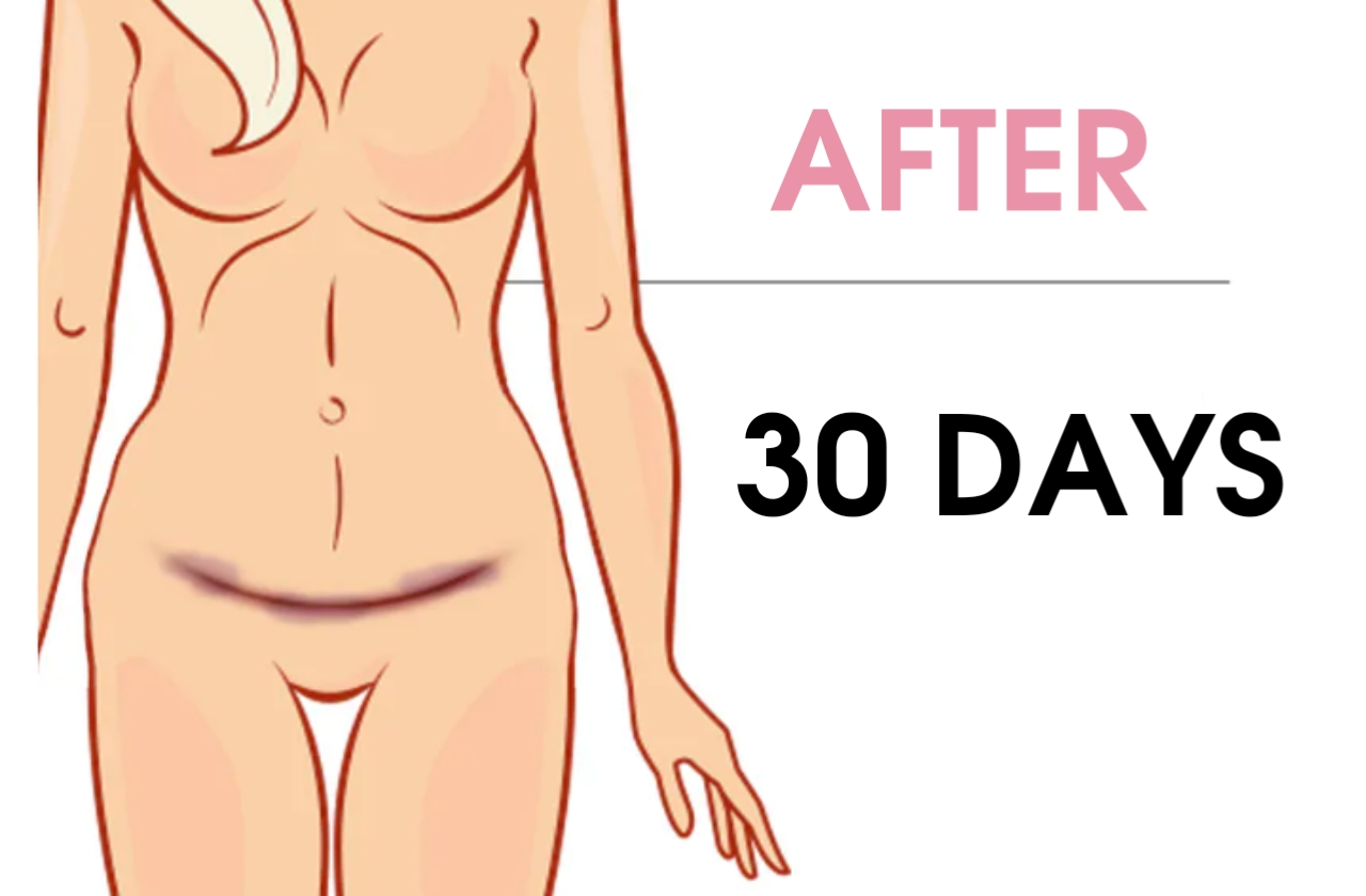 What are the results of abdominoplasty after 30 days?