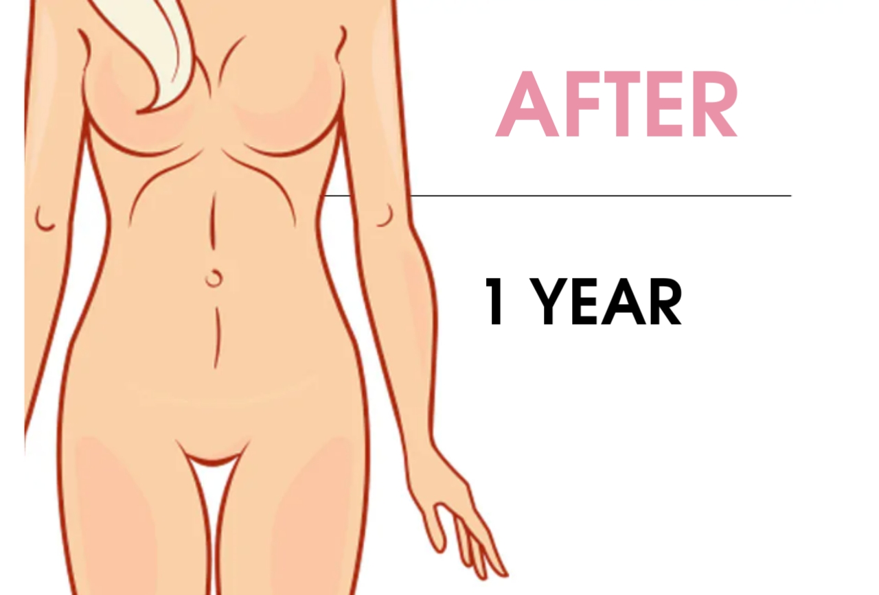 How is the tummy tuck belly after 1 year?
