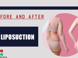 Before And After Liposuction - Lipo Results On The Belly, Back, Flanks And Culottes For You To Be Inspired!