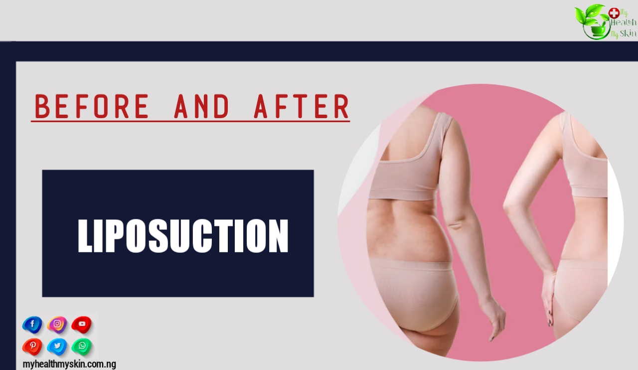 Before And After Liposuction - Lipo Results On The Belly, Back, Flanks And Culottes For You To Be Inspired!