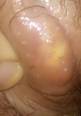 Pimple Like Bump On Clitorial Hood