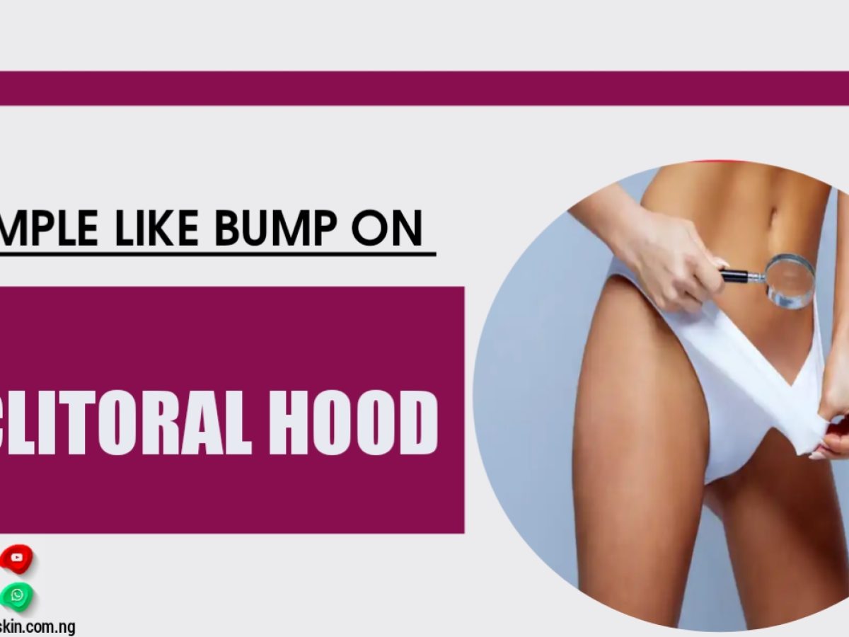 Pimple Like Bump On Clitorial Hood