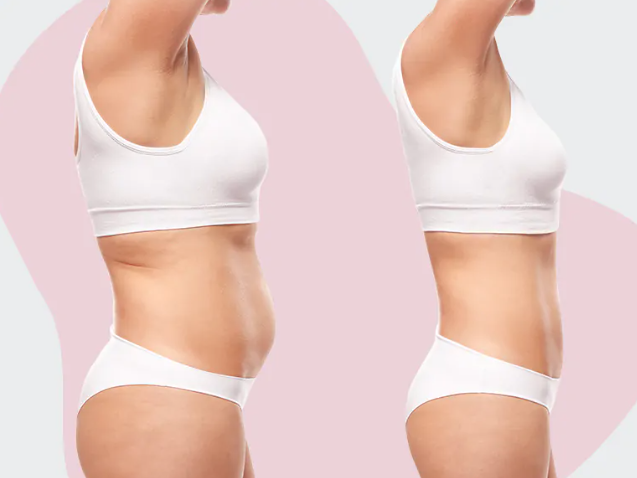 result of abdominal liposuction
