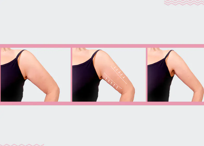 Results of liposuction on the arm