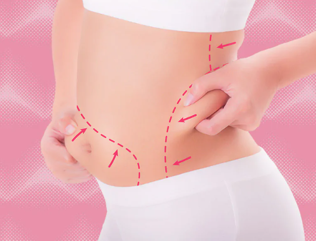 3 main doubts about liposuction before and after the result!