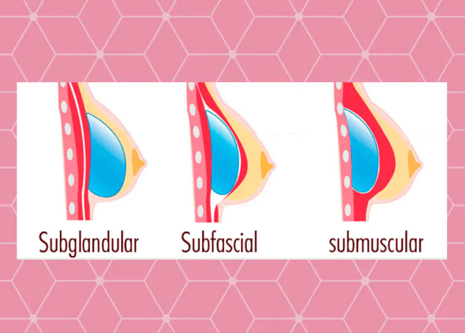 Breasts with silicone before and after, what to evaluate: 
