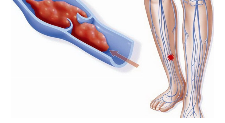 deep vein thrombosis