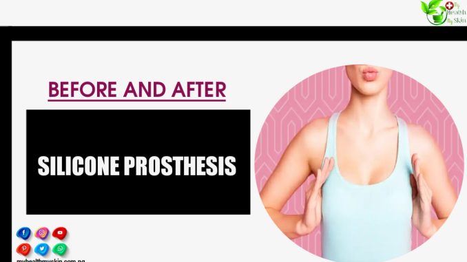 Silicone Prosthesis Before And After: Everything You Need To Know To Achieve The Result Of Your Dreams