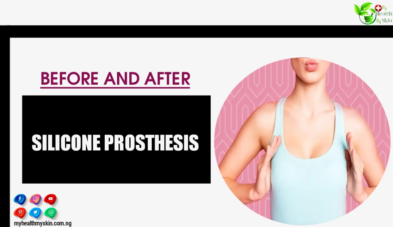 Silicone Prosthesis Before And After: Everything You Need To Know To Achieve The Result Of Your Dreams