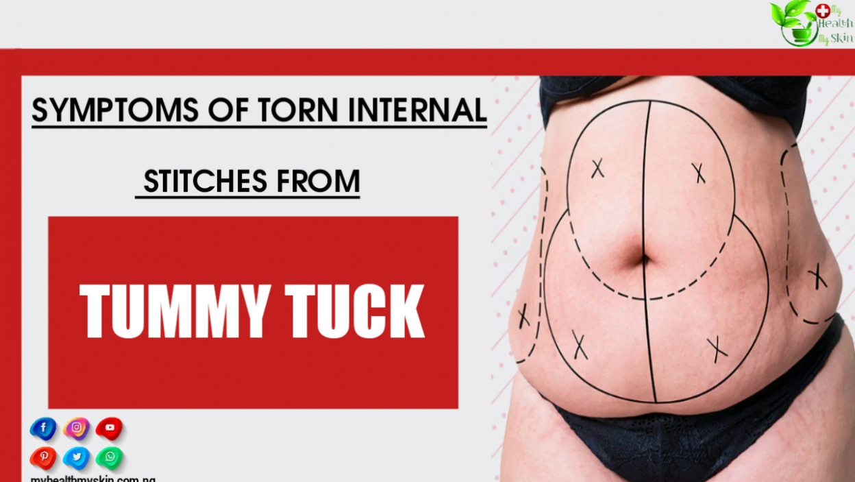 Symptoms Of Torn Internal Stitches From Tummy Tuck (Abdominoplasty): What To Do And How To Treat!