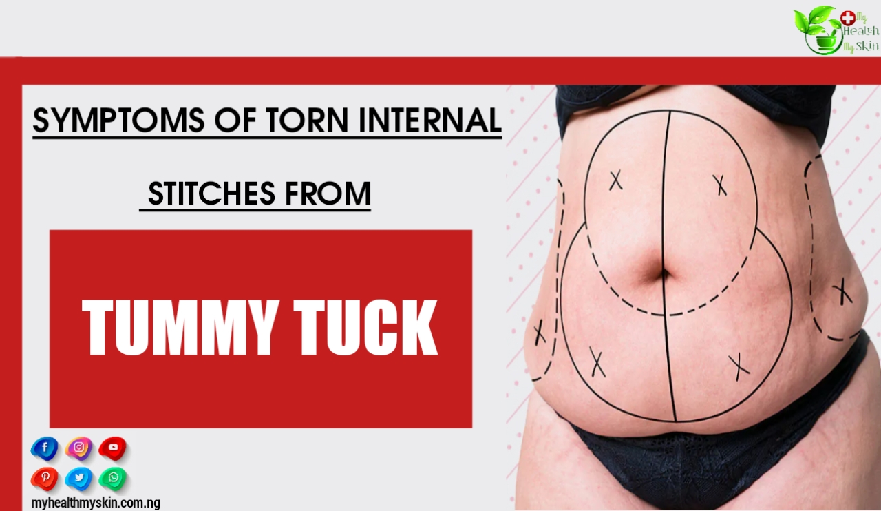 Symptoms Of Torn Internal Stitches From Tummy Tuck (Abdominoplasty): What To Do And How To Treat!