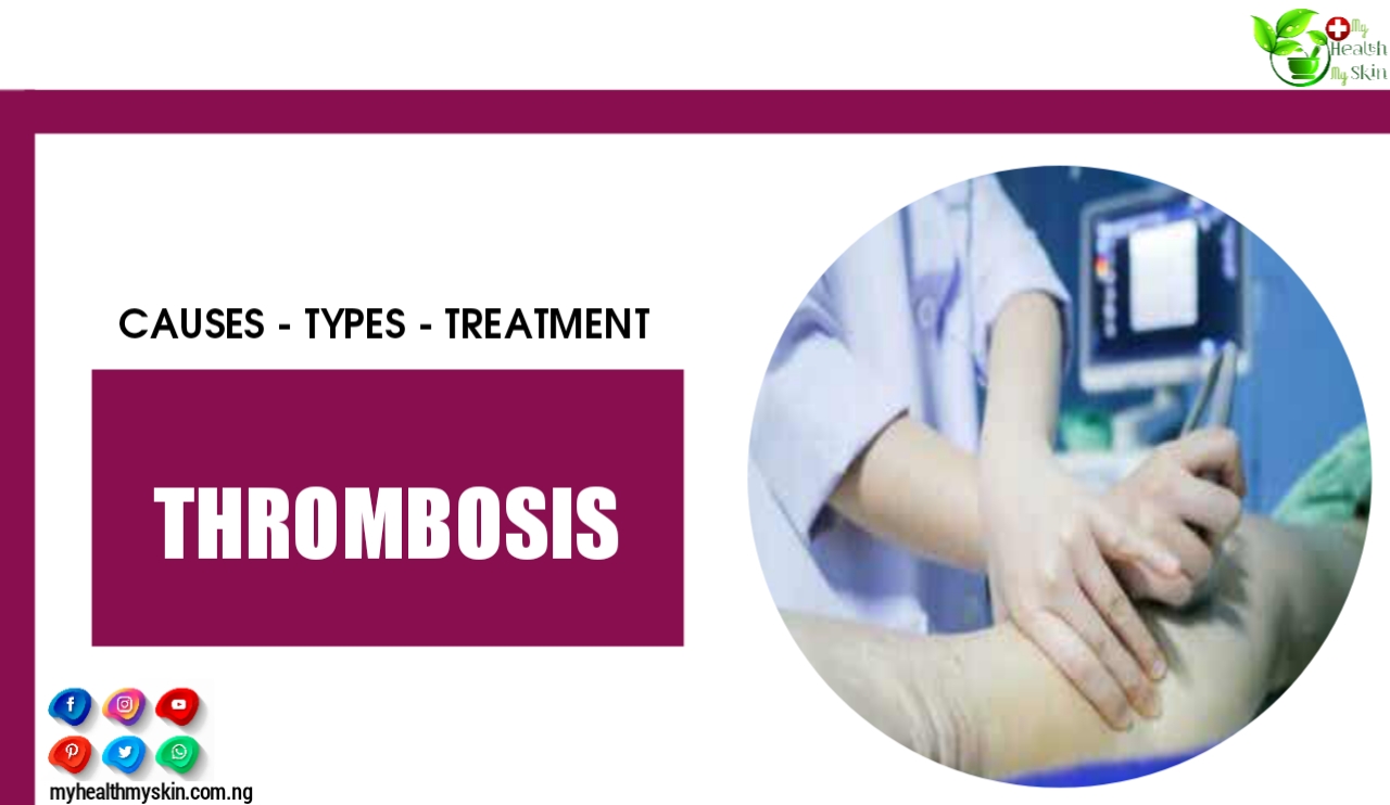 Thrombosis – Causes, Types And Treatment