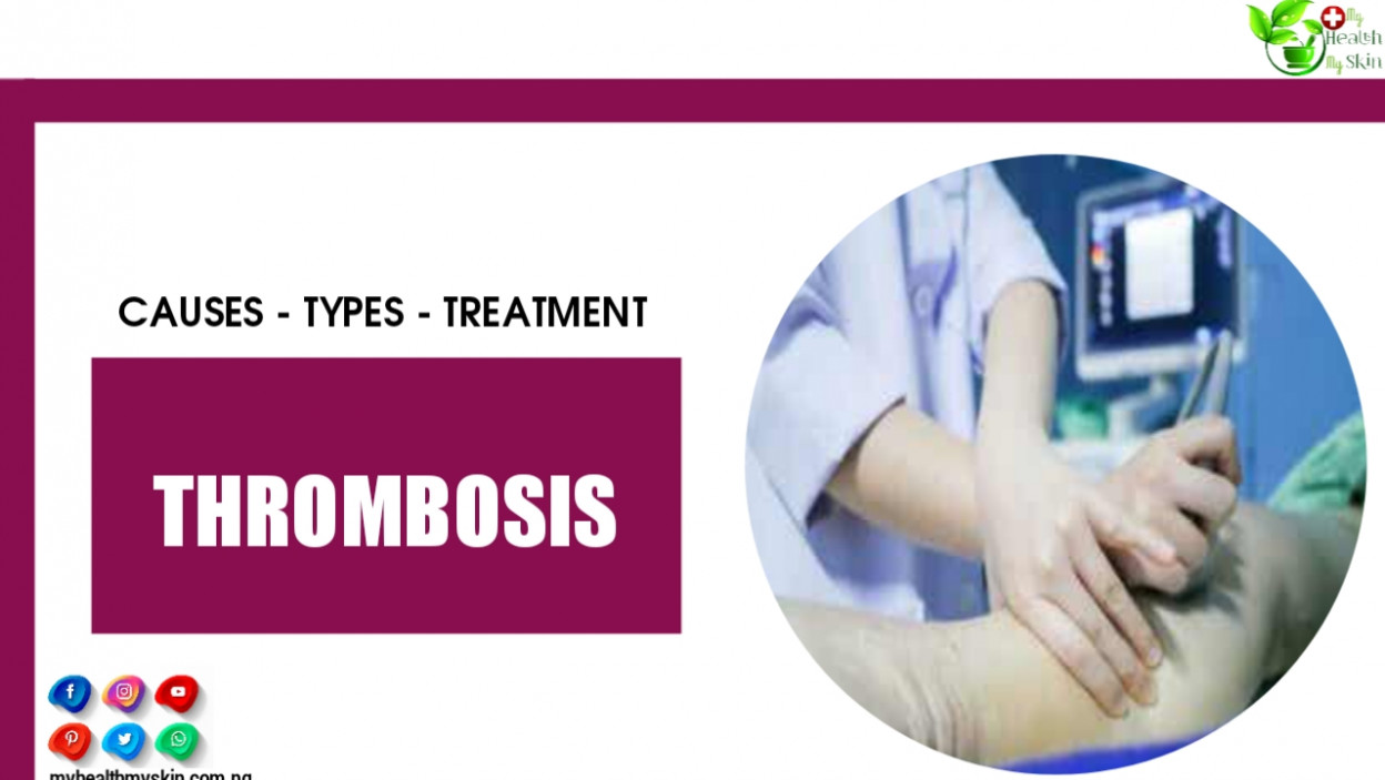 Thrombosis – Causes Types And Treatment