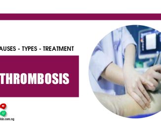 Thrombosis – Causes, Types And Treatment